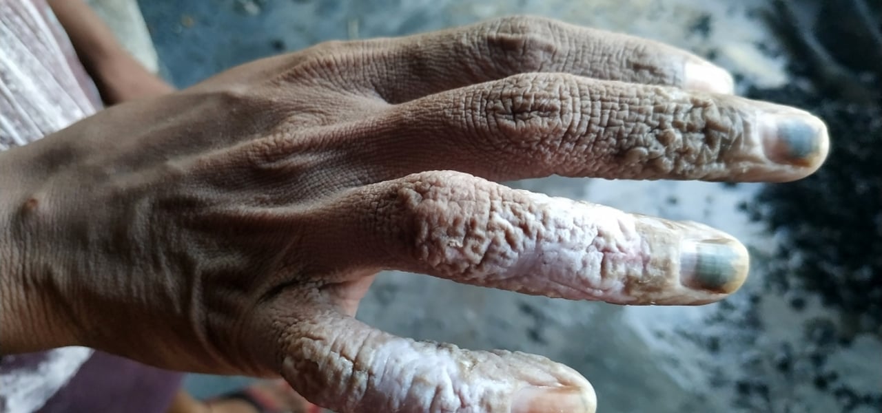 2019 09 BAN Sericulture Hand of a bonded labourer
