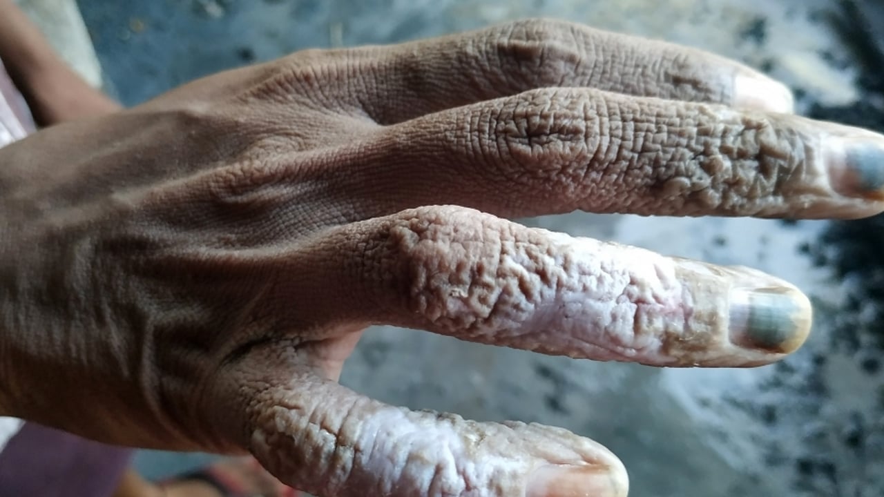 2019 09 BAN Sericulture Hand of a bonded labourer