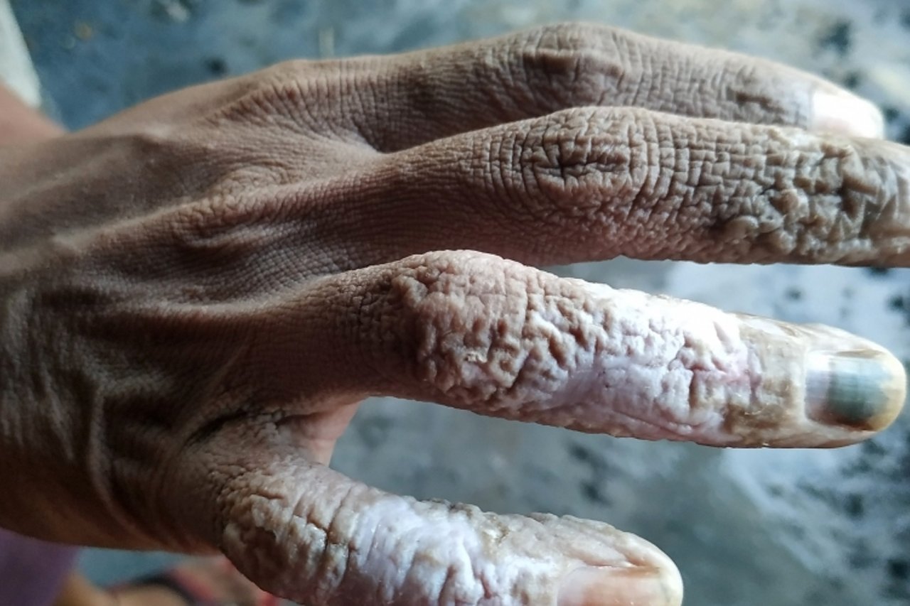 2019 09 BAN Sericulture Hand of a bonded labourer
